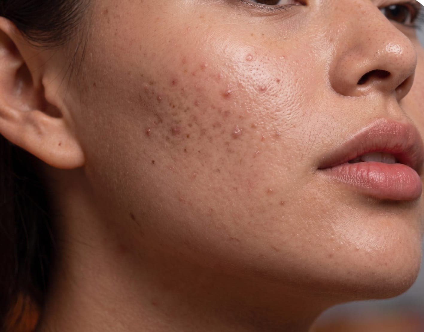 Acne and blemishes skin concern